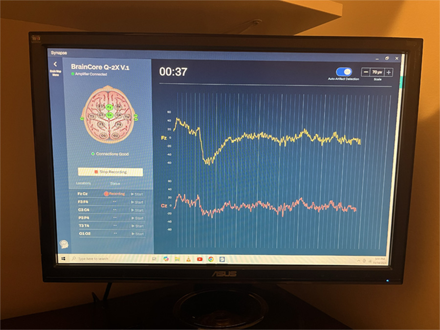 BrainCore brainmap computer output for a QEEG testing  in Smithtown