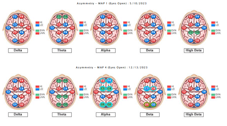 brainmap-qeeg-anxiety-3