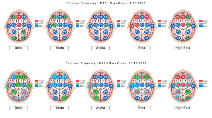 brainmap-qeeg-anxiety-4