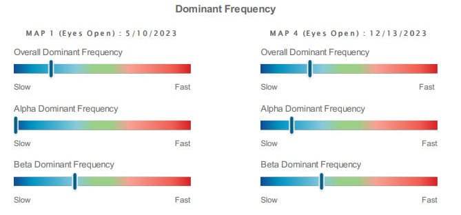 brainmap-qeeg-anxiety-6