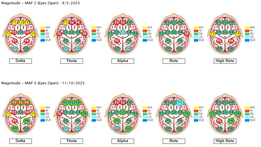 What the Colors of the qEEG Brain Map Mean